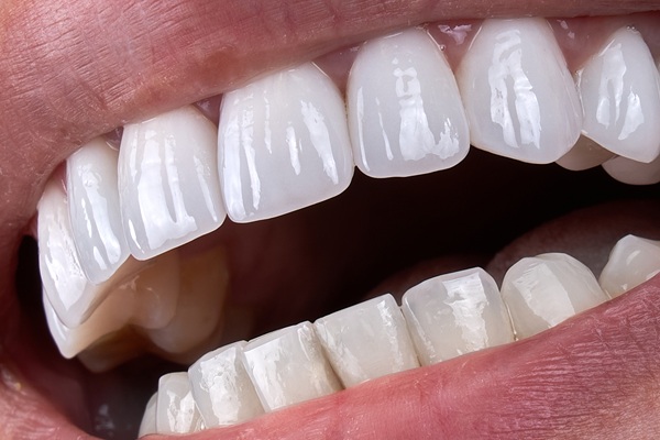 Dental Bonding Explained: How It Fixes Chips, Gaps &#   ; Stains